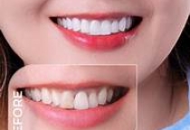 DÁN SỨ VENEER