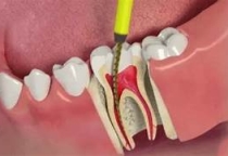 ĐIỀU TRỊ TỦY
