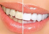 TẨY TRẮNG RĂNG