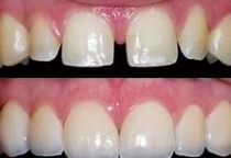 TRÁM RĂNG THẨM MỸ ĐẮP 